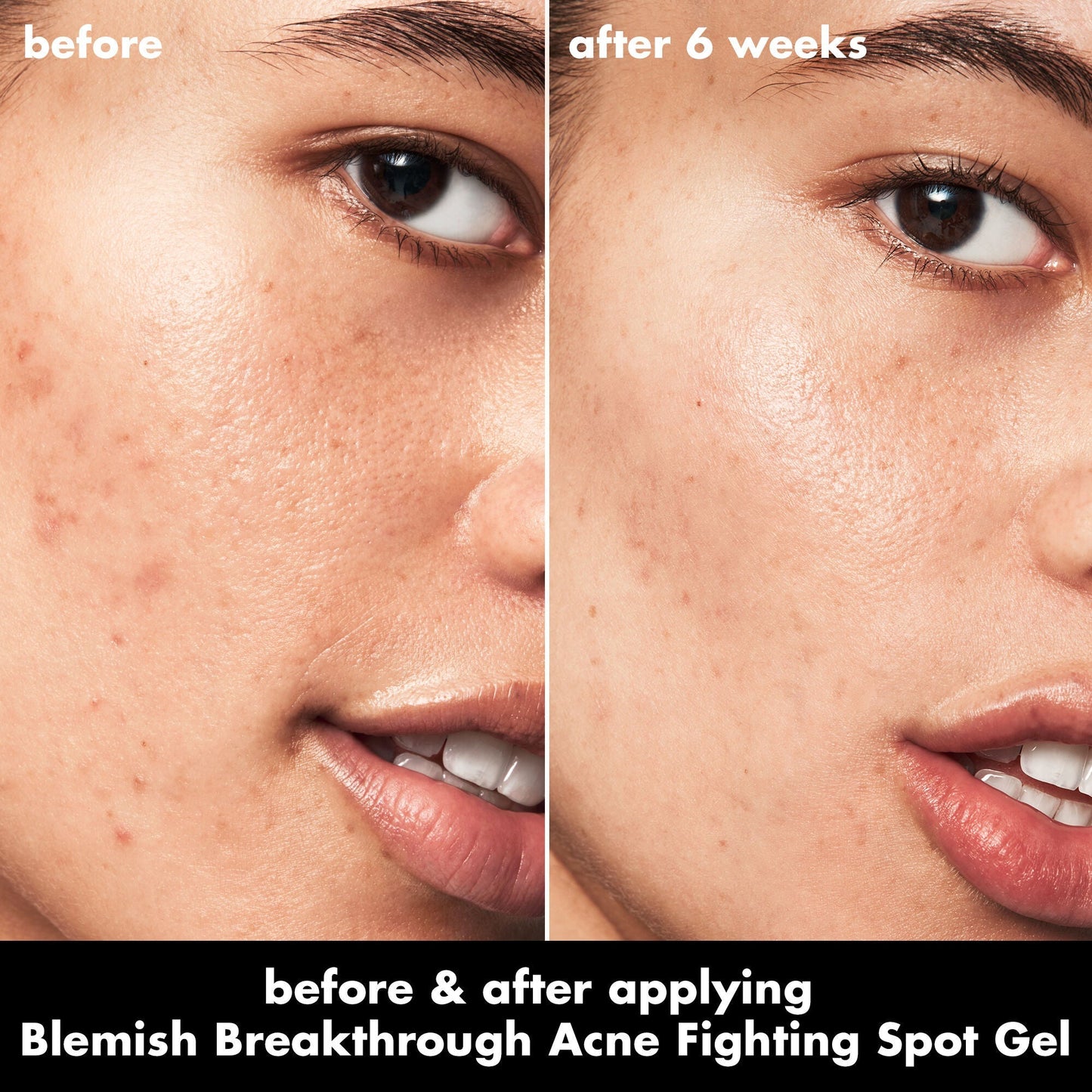blemish-breakthrough-acne-fighting-spot-gel-z3 0326_EDU_BB_SpotGel_BA_ISABELLA.jpg