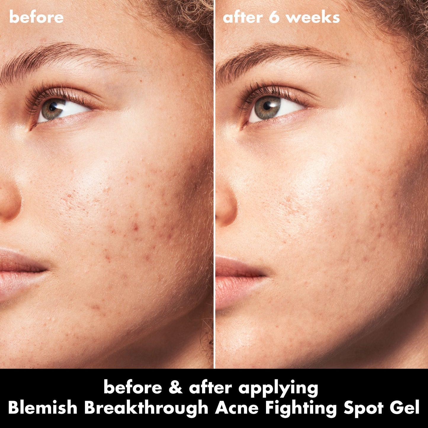 blemish-breakthrough-acne-fighting-spot-gel-z3 0326_EDU_BB_SpotGel_BA_MARLEY.jpg