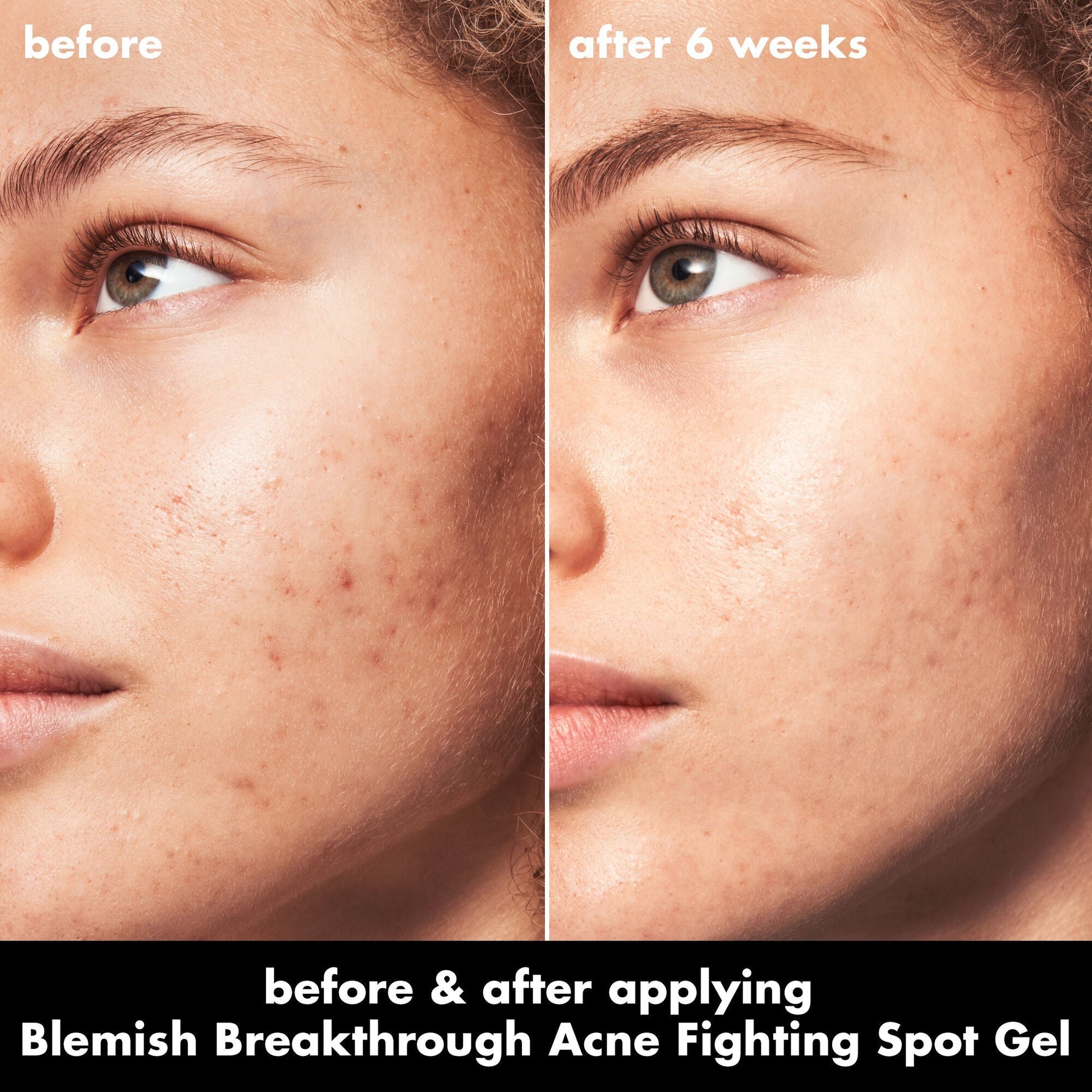 blemish-breakthrough-acne-fighting-spot-gel-z3 0326_EDU_BB_SpotGel_BA_MARLEY.jpg