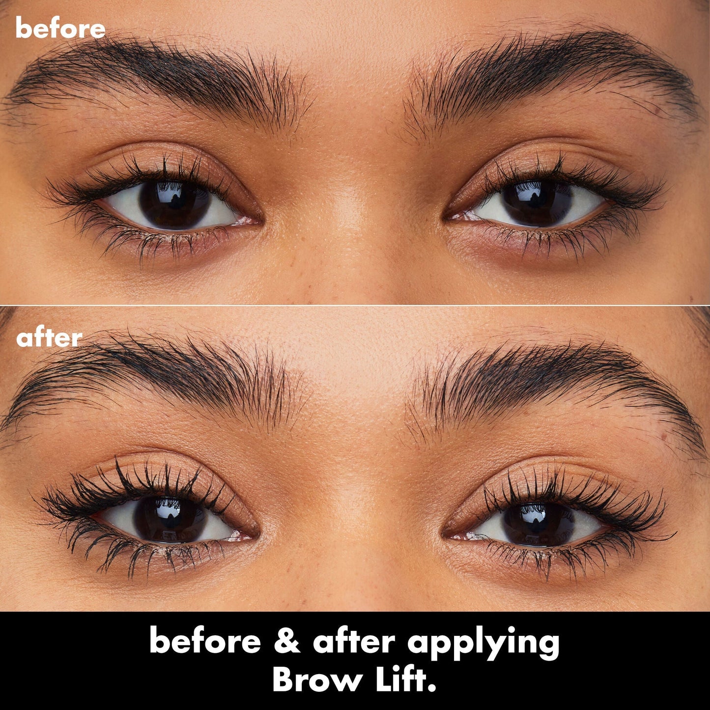 brow-lift-k7 0326_EDU_BrowLift_BA.jpg
