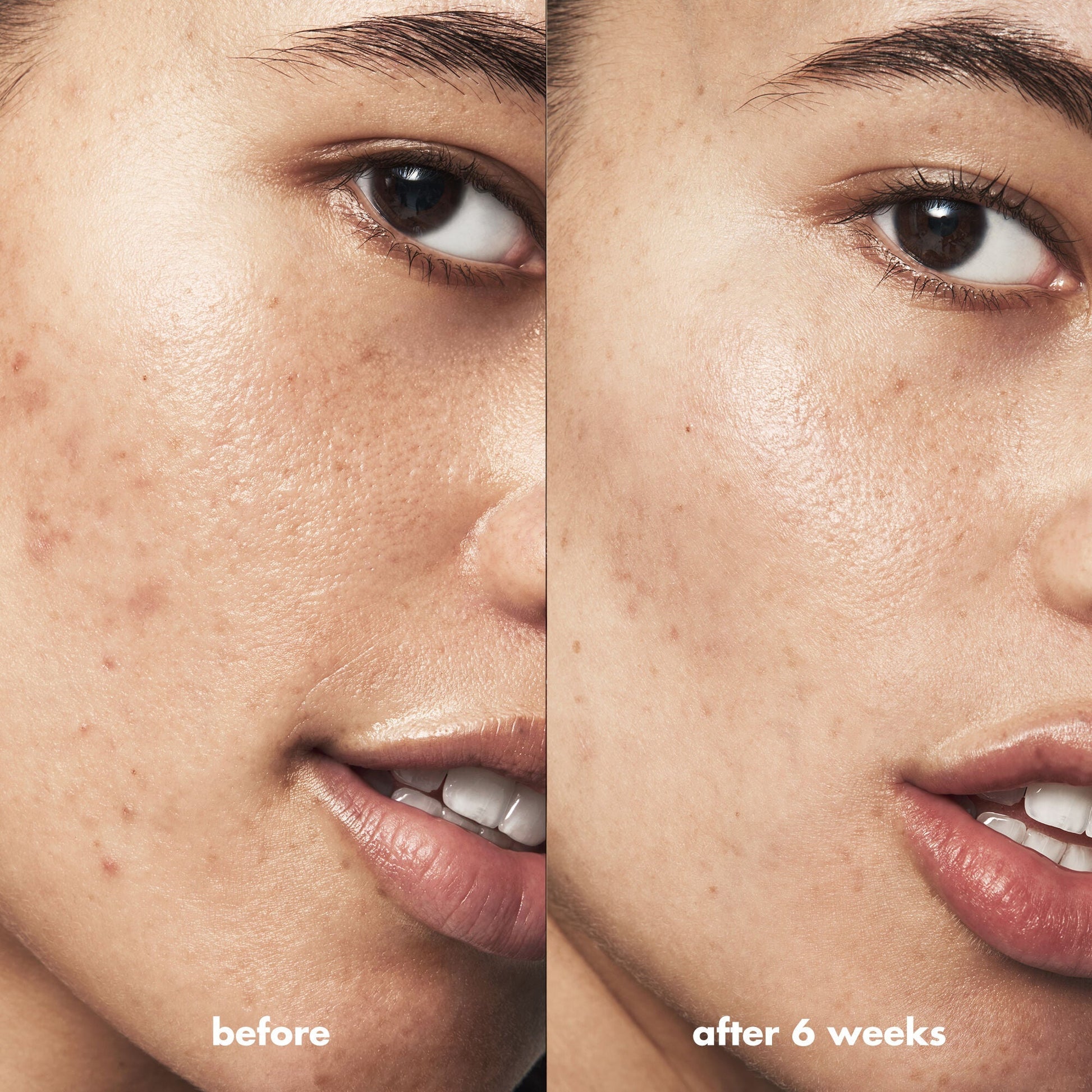 blemish-breakthrough-acne-calming-water-cream-mini-i9 Acne_PDP_Isabella_Before_After_f0d452cd-72f5-4bb8-a6df-0b3cc23143ef.jpg