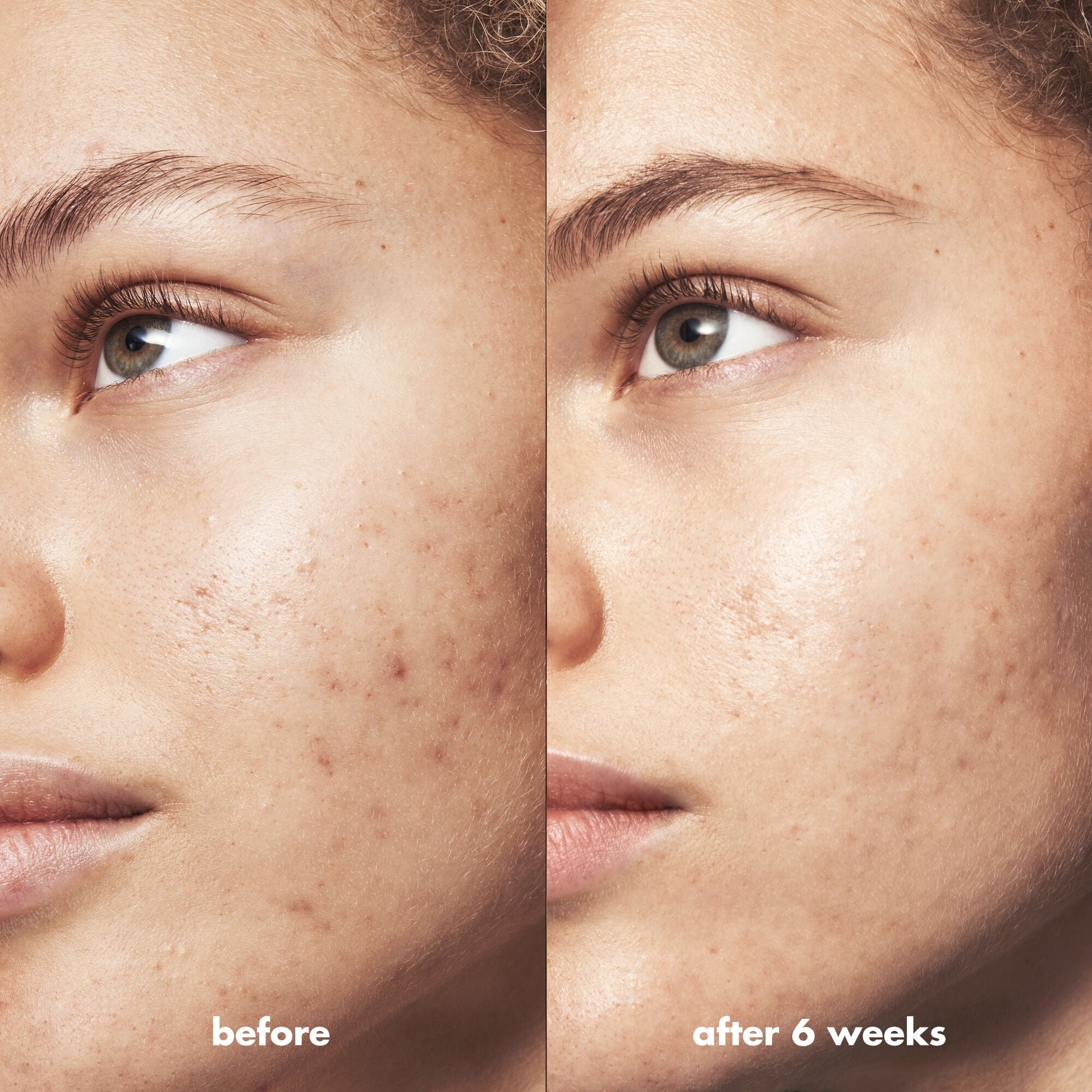 blemish-breakthrough-acne-calming-water-cream-c5 Acne_PDP_Marley_Before_After_be0f6ee7-ce12-4695-83d7-5ec5f0498e19.jpg